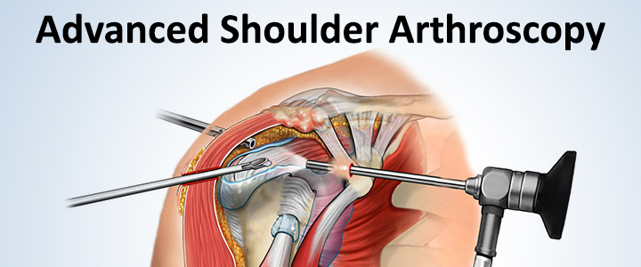 Advanced Shoulder Arthroscopy in Delhi