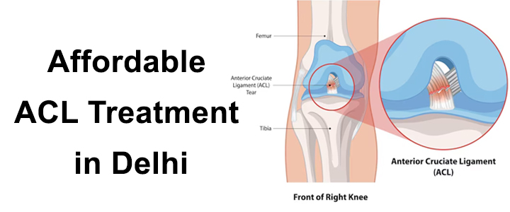 Affordable ACL Treatment in Delhi