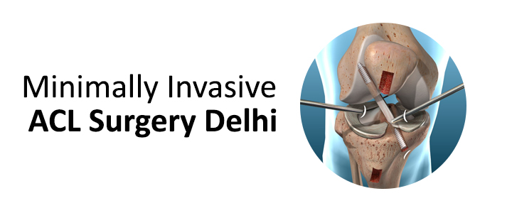 Minimally Invasive ACL Surgery Delhi
