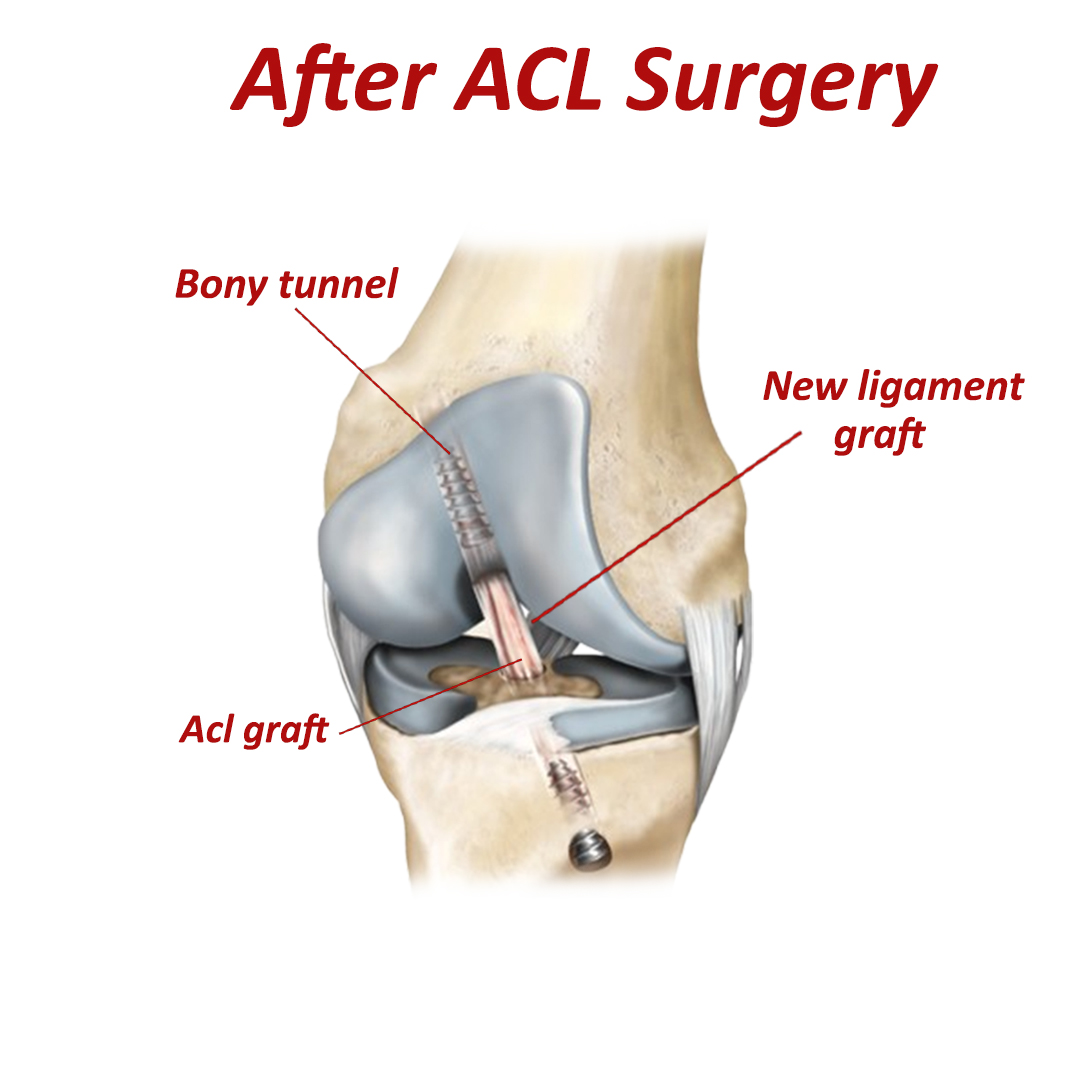 ACL Surgery