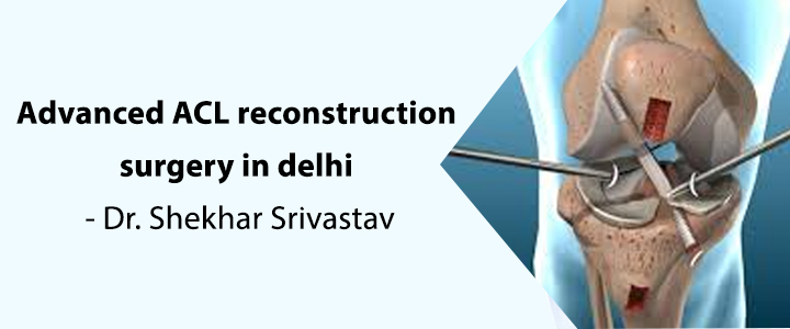 Advanced ACL Reconstruction Surgery in Delhi – Dr. Shekhar Srivastav