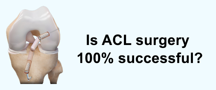 Is ACL Surgery 100% Successful?