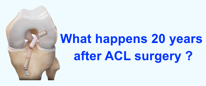 What happens 20 years after ACL Surgery?