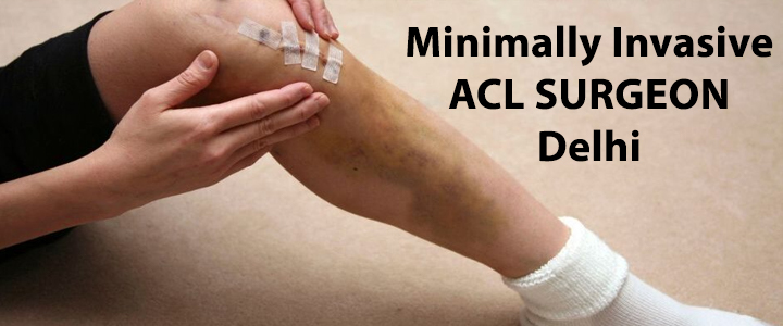 Minimally Invasive ACL Surgeon Delhi
