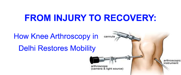 Knee Arthroscopy in Delhi