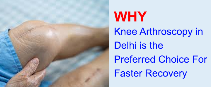 Knee Arthroscopy in Delhi