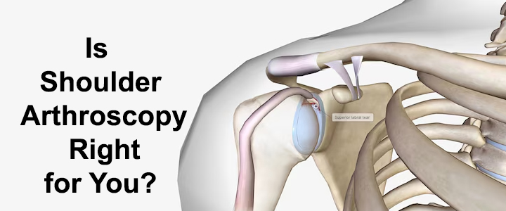 Shoulder Arthroscopy