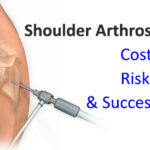 Shoulder Arthroscopy Surgery