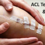 ACL Tear Treatment