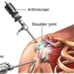 Rotator Cuff Tear