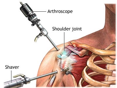 Rotator Cuff Tear