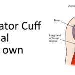 Arthroscopy Rotator Cuff Repair