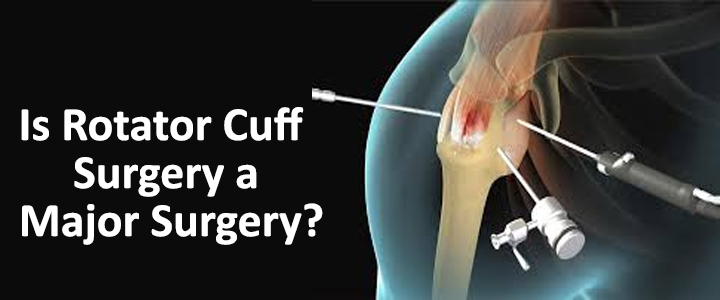 Is Rotator Cuff Surgery a Major Surgery?