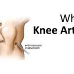 Knee Replacement Surgery