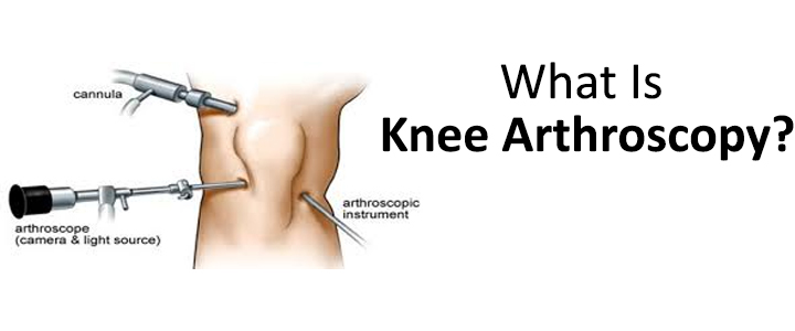 What Is Knee Arthroscopy?