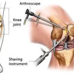cost of ACL reconstruction surgery in Delhi