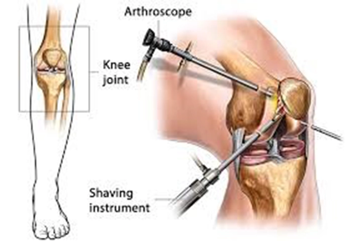 cost of ACL reconstruction surgery in Delhi