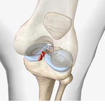 ACL Tear vs. MCL Tear