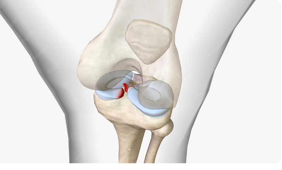 ACL Tear vs. MCL Tear