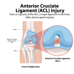 ACL Surgery Recovery