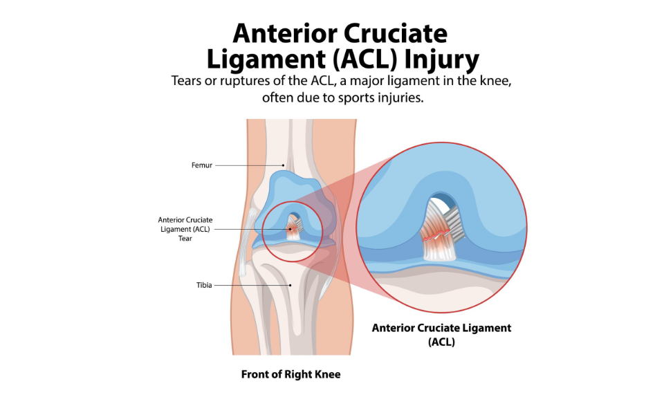ACL Surgery Recovery