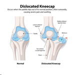 ACL Graft