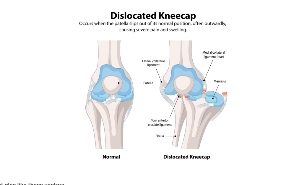 ACL Graft