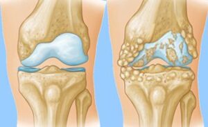 osteoarthritis-causes
