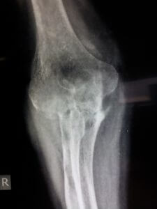 elbow-arthroplasty-6