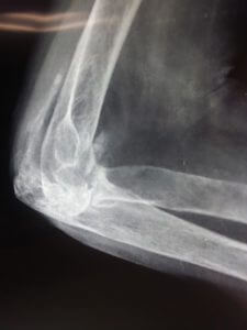 elbow-arthroplasty-5