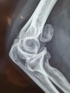 elbow-arthroscopy-4