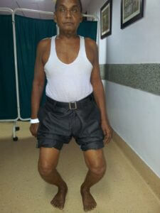 total-knee-replacement-before