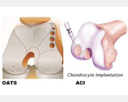 cartilage-injuries