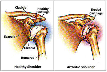 total-shoulder-replacement