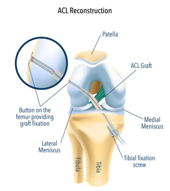 ACL Reconstruction Technique