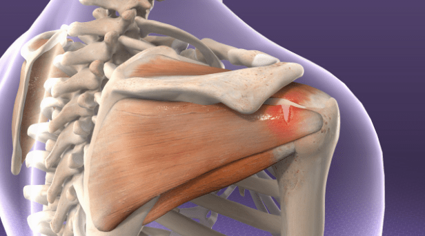 How to Maintain Your Shoulder Joint's Health and Happiness by Dr Shekhar Srivastav
